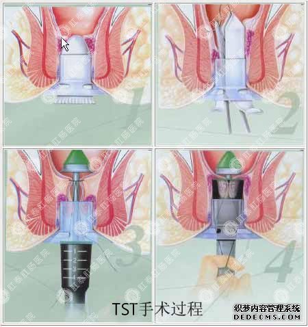 友好TST手术过程